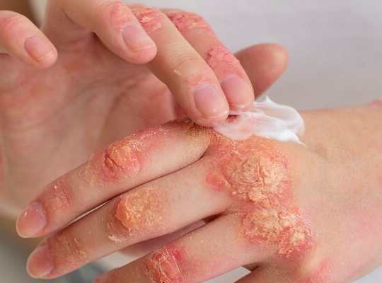 burned blistered hands