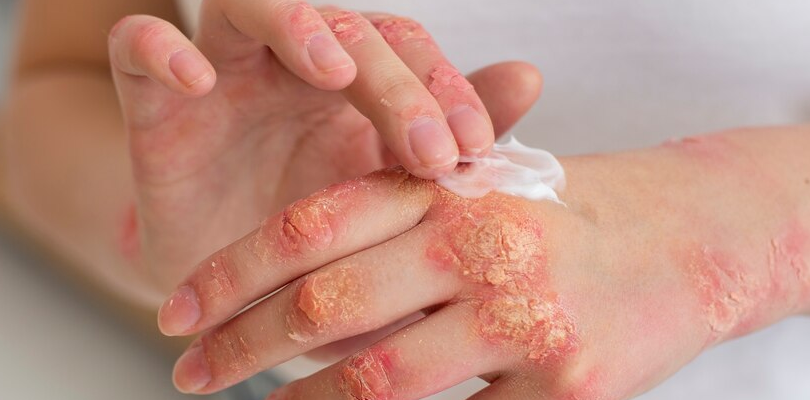 burned blistered hands