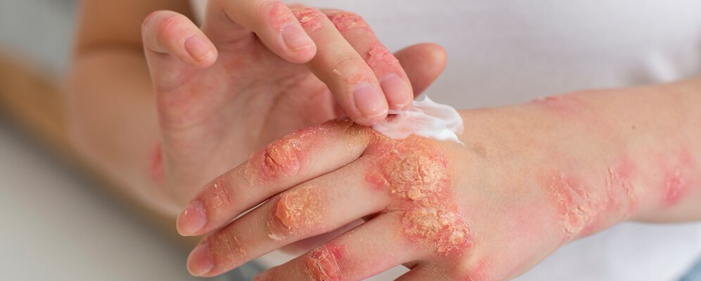 What to do with burn blister discount