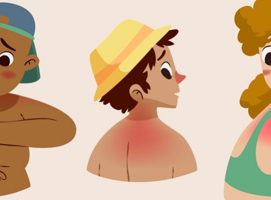 Burn Blister Characters
