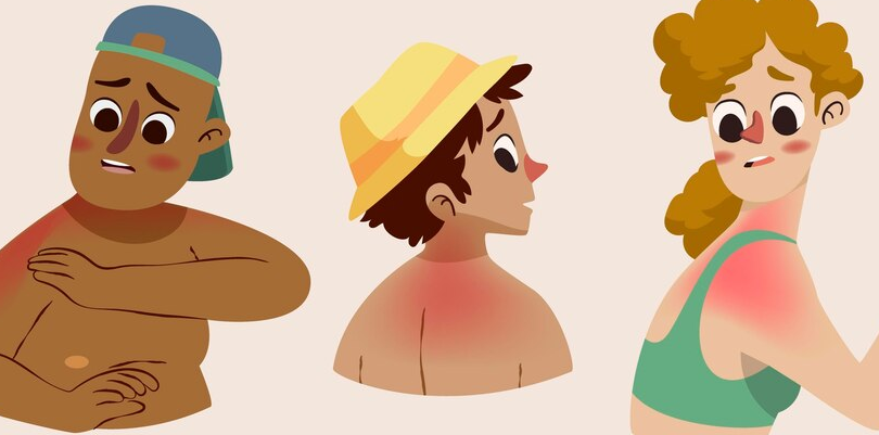 Burn Blister Characters