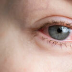 First Aid for Eye Scratches: What to Do and How Our Eye Care Kit Can Help