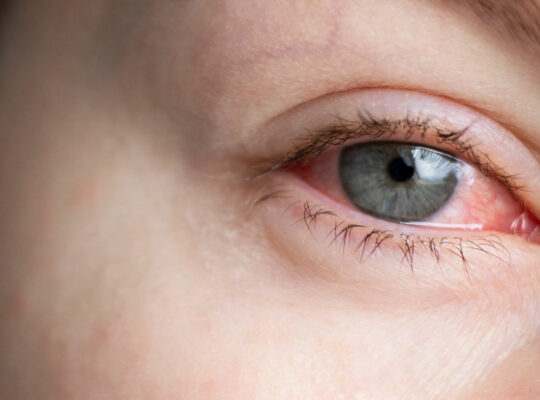eye injury red eye-01
