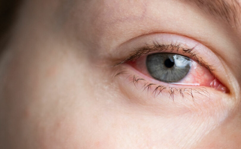 eye injury red eye-01
