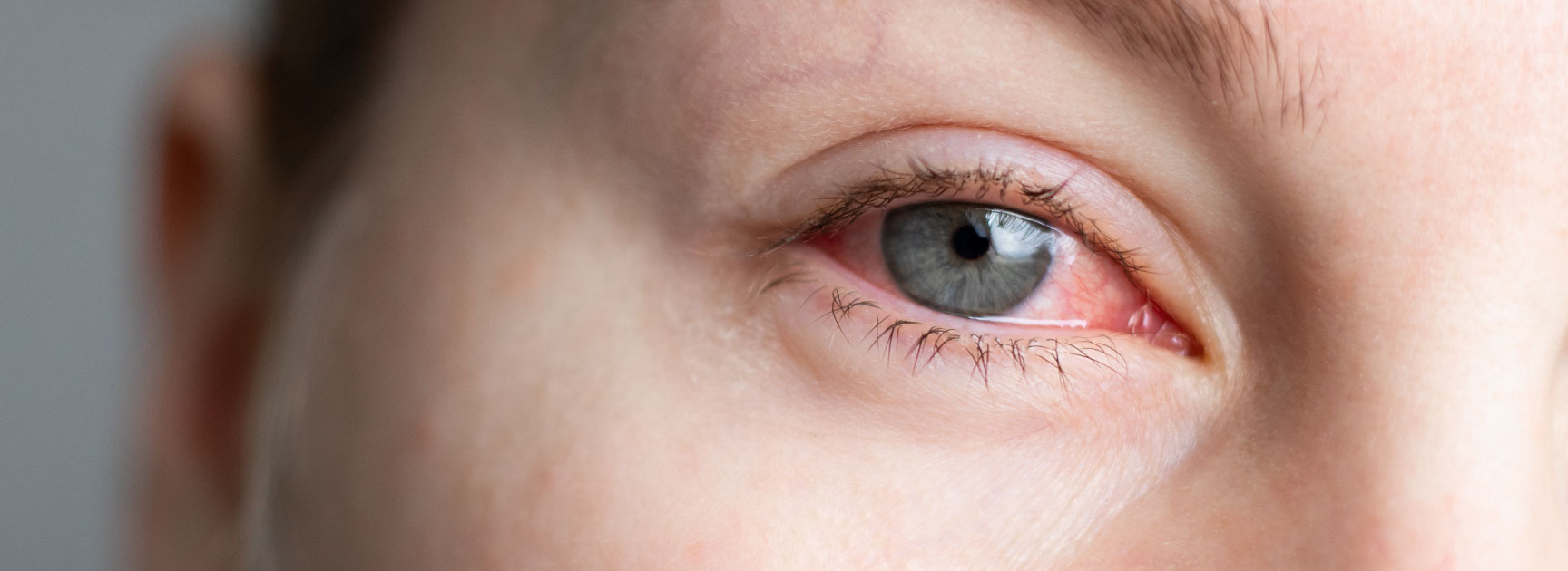 eye injury red eye-01